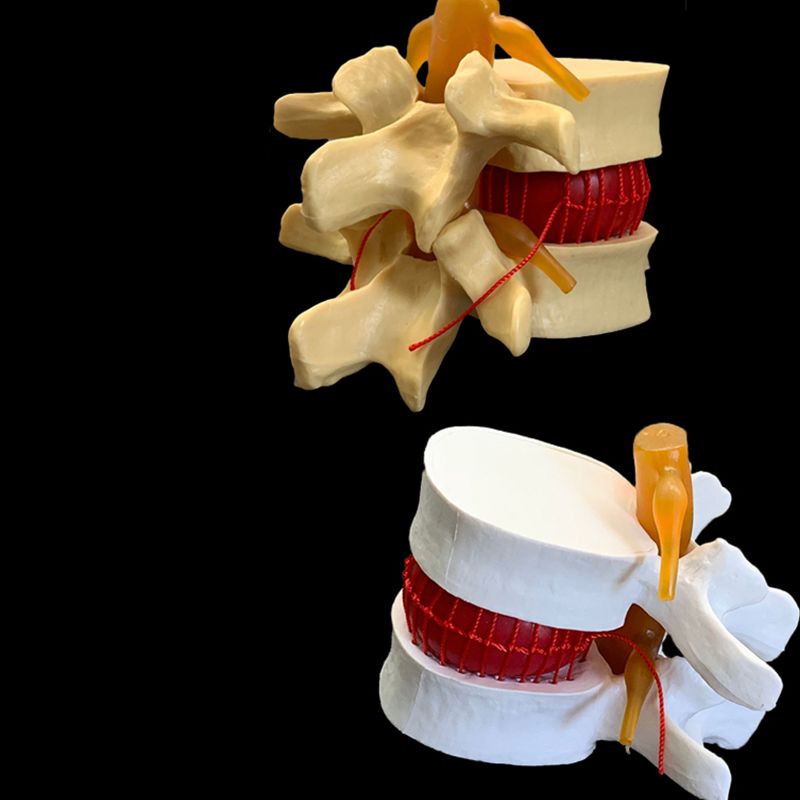 Anatomical Human Lumbar Vertebrae Degenerative Lumbar Disc Herniation Demonstration Model Human Spine Model - White, Yellow