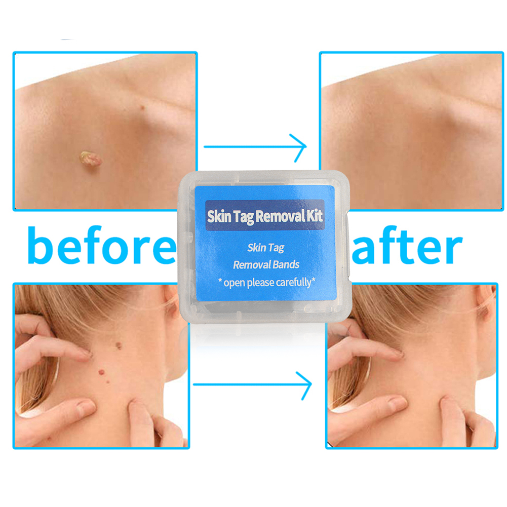 30pcs/box%20Flesh%20Nevus%20Removal%20Bands%20Non-Toxic%20Mole%20Removal%20Rubber%20Bands%20Kit%20Wart%20Treat%20Tool%20for%20Men%20Women%20Face%20Skin%20Care%20-%20Image%202