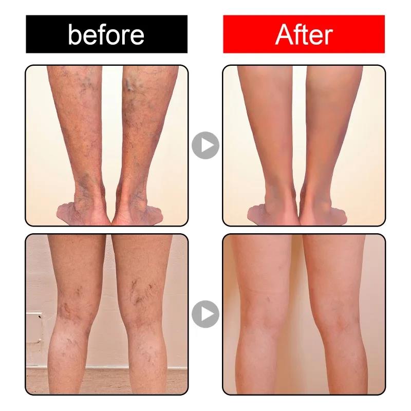 New%20model%20Varicose%20Veins%20Patch%20Relief%20Leg%20Vasculitis%20Spider%20Varicose%20Vein%20Patches%20Varicose%20Veins%20For%20Legs%20Improve%20Blood%20Foot%20Health%20Care%20-%20Image%204