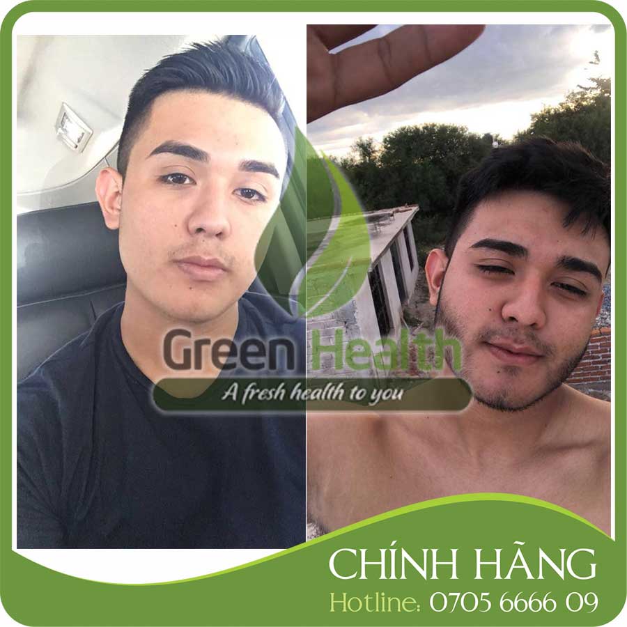 (Tặng Peo Mix) Minoxidil 10% Mintop Hỗ Trợ Mọc Râu, Tóc