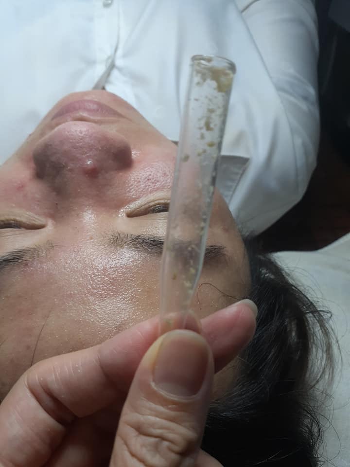 Combo 10 ống hút mụn thủy tinh cho spa