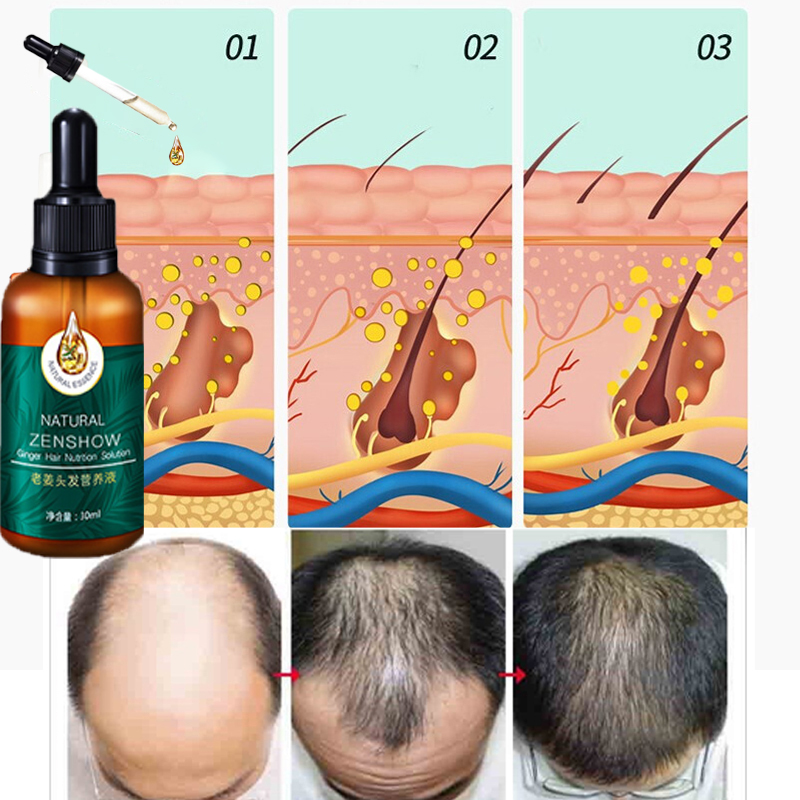 Tinh dầu dưỡng tóc già gừng vua dung dịch dưỡng tóc 30ml dung dịch dưỡng tóc gừng vua tinh dầu dưỡng tóc