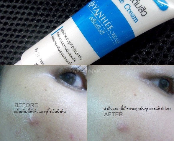 Kem mụn Yanhee Acne Cream Thái Lan