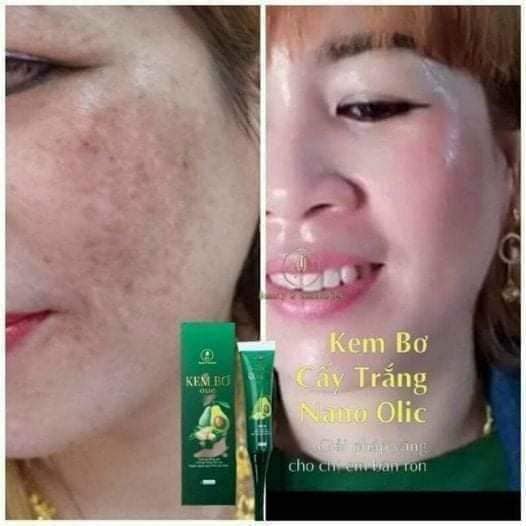 KEM BƠ CẤY TRẮNG NANO OLIC