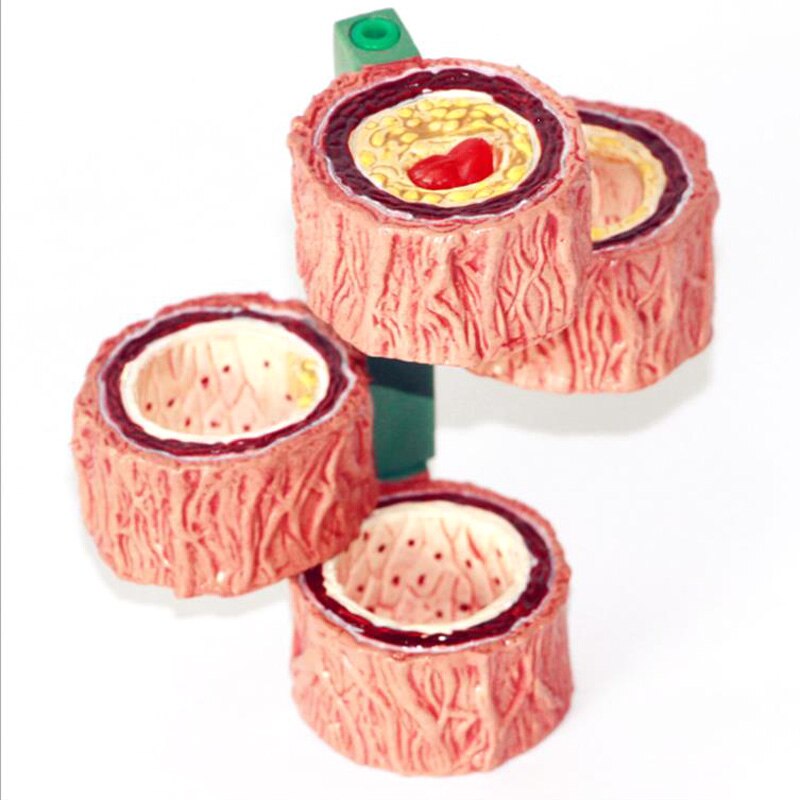 Blood Vessel Human Hardening Of The Arteriosclerosis Model Human Anatomy Anatomical Model Teaching Supplies Tools