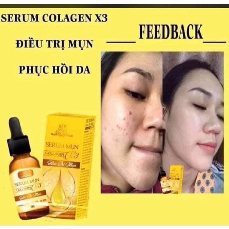Serum mụn collagen x3 chính hãng