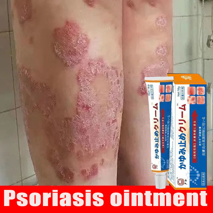 Nhật Bản Kem bôi vẩy nến, viêm da kháng khuẩn đánh bay nấm da, chống ngứa viêm da, hắc lào, lang ben, mề đay, viêm da cơ địa, á sừng, vảy nến, tổ đỉa, viêm da dầu, viêm da dị ứng