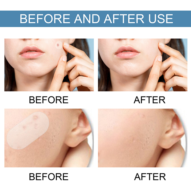 80 Pcs Acne Pimple Patches Stickers Acne Spot Treatment Patch Blemish ...