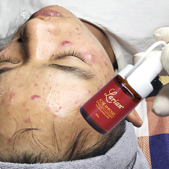 Tế bào gốc trị Mụn DNA cá hồi (LARIAN ACNE AMPOULE)