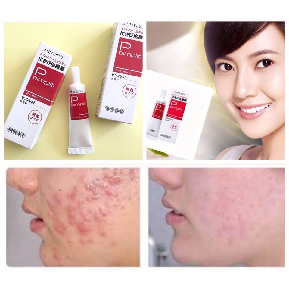 Kem Chấm Mụn Shiseido Pimplit Nhật Bản - Tuýp 18g