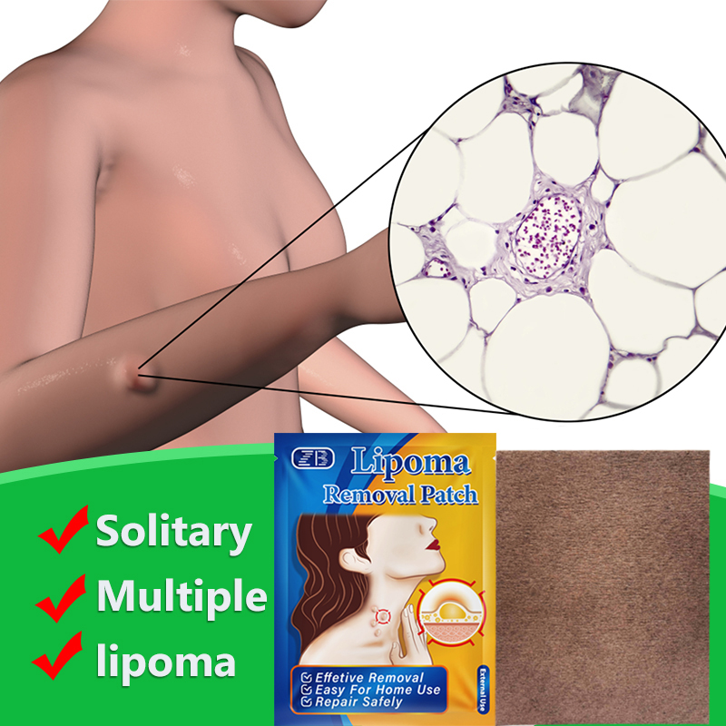 Tanggeri%20Fashion%206Pcs%20Lipoma%20Removal%20Paste%20Fatty%20Lump%20Removal%20Patch%20SKU:YG-2059@#SMT1234yjz%20-%20Image%203