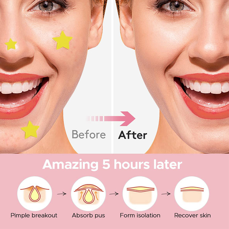 600%20PCS/SET%20Star%20Pimple%20Patch%20Acne%20Colorful%20Invisible%20Acne%20Removal%20Skin%20Care%20Stickers%20Concealer%20Face%20Spot%20Beauty%20Makeup%20Tools%20MENGYU%20-%20Image%205