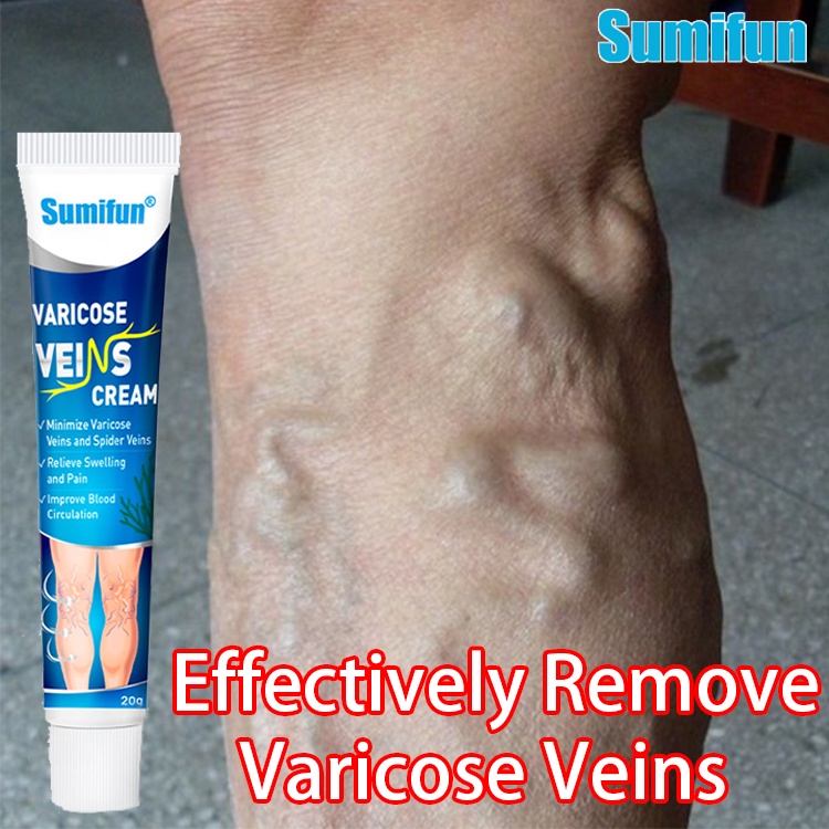 Varicose veins remover for legs for varicose analgesia, antivaricose
