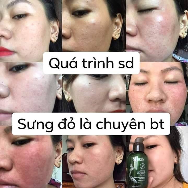 [Chính Hãng] Serum Thay Da Nhân Sâm MQ Skin Chính Hãng