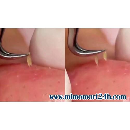 Nhíp nhổ mụn đầu đen Vetus