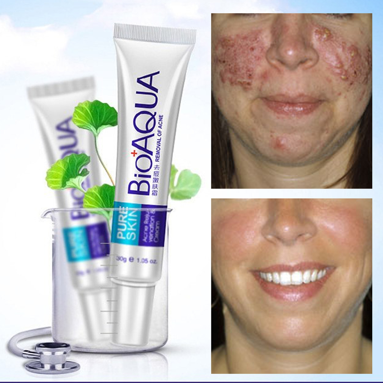 review bioaqua removal of acne