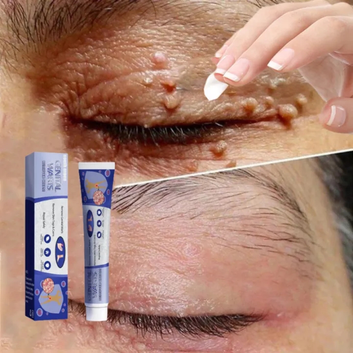 South Moon Wart Remoal Cream Tẩy nốt ruồi, mụn cóc ,tàn nhang ,mụn thịt , mắt cá hiệu quả