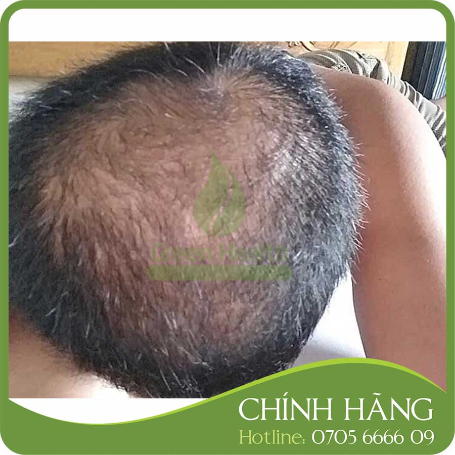 Dung dịch hỗ trợ mọc tóc Hair 4U Pro