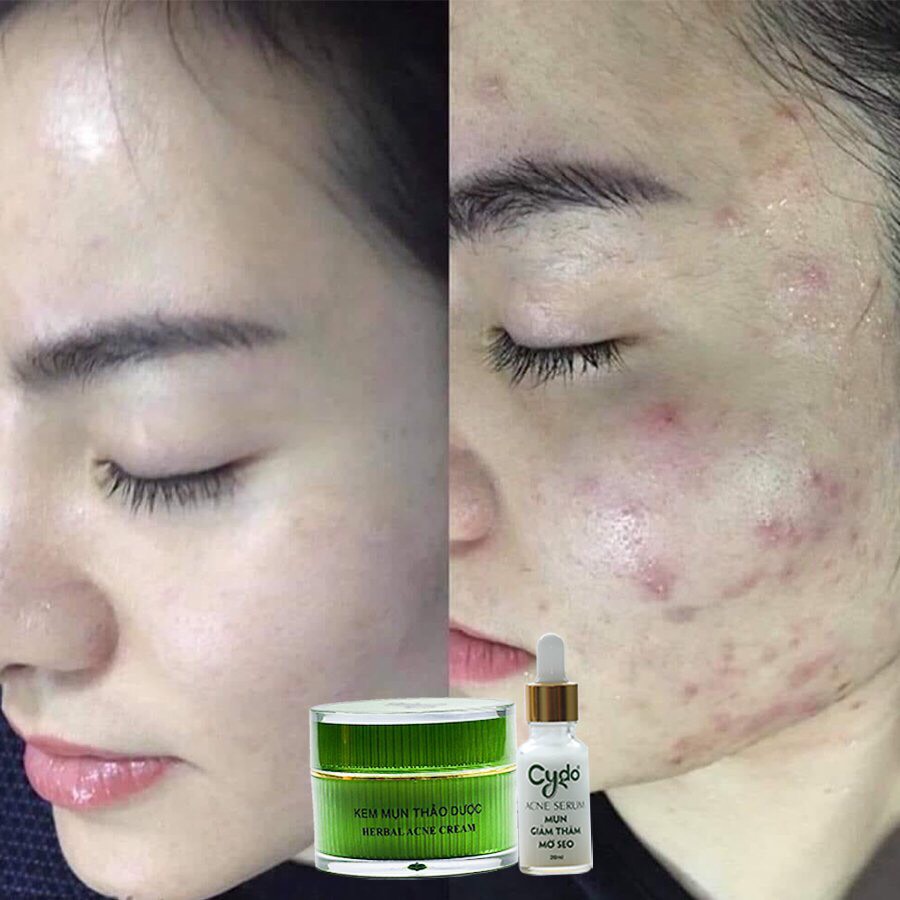 KEM MỤN THẢO DƯỢC CYDO