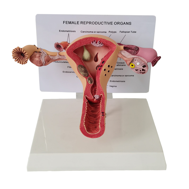 【Latest Style】 anatomical female uterus ovary model with pathologies.