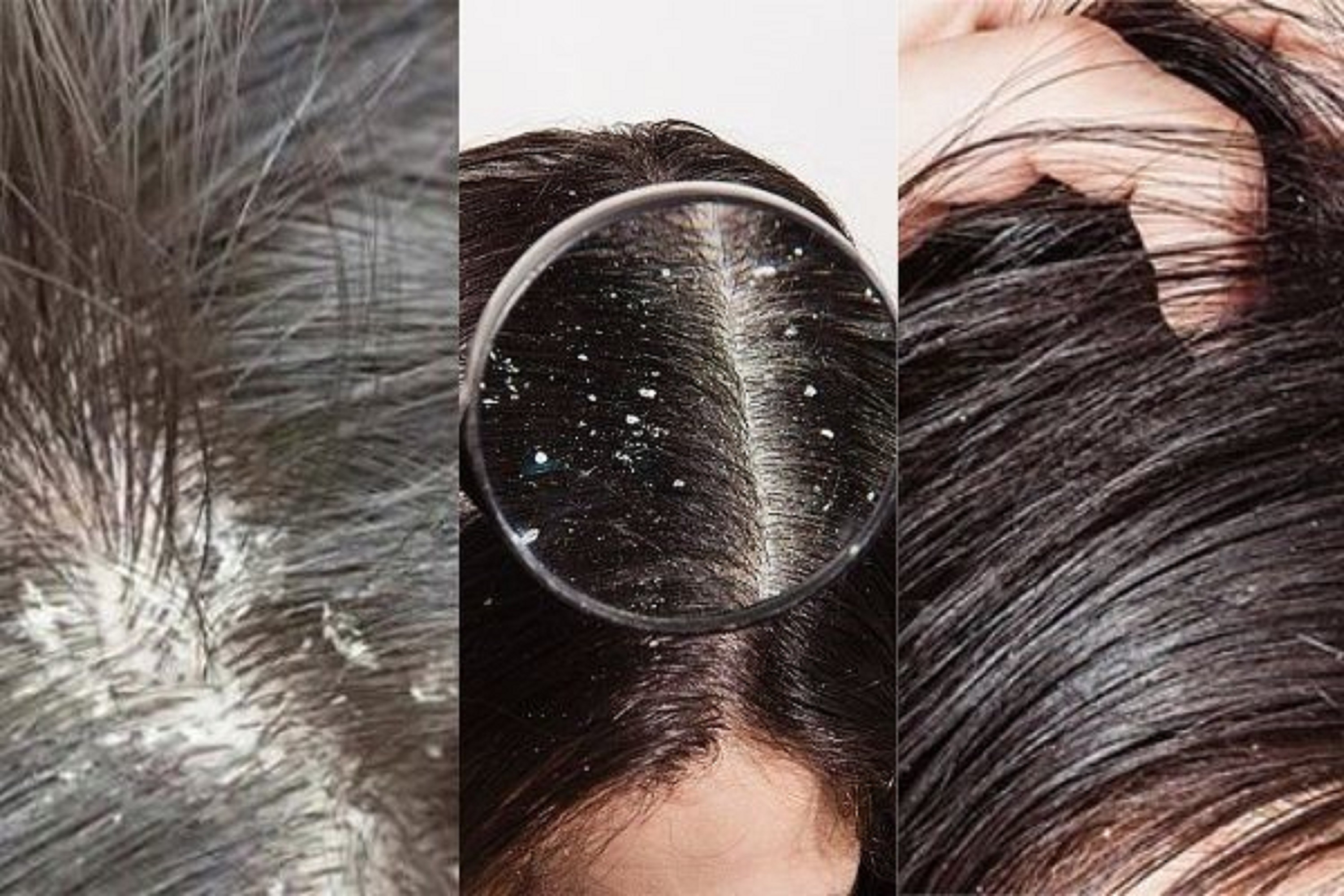 [CHÍNH HÃNG] Dầu Gội Gàu Nấm DRCELL(Loại Bỏ Gàu Nấm Da Đầu)