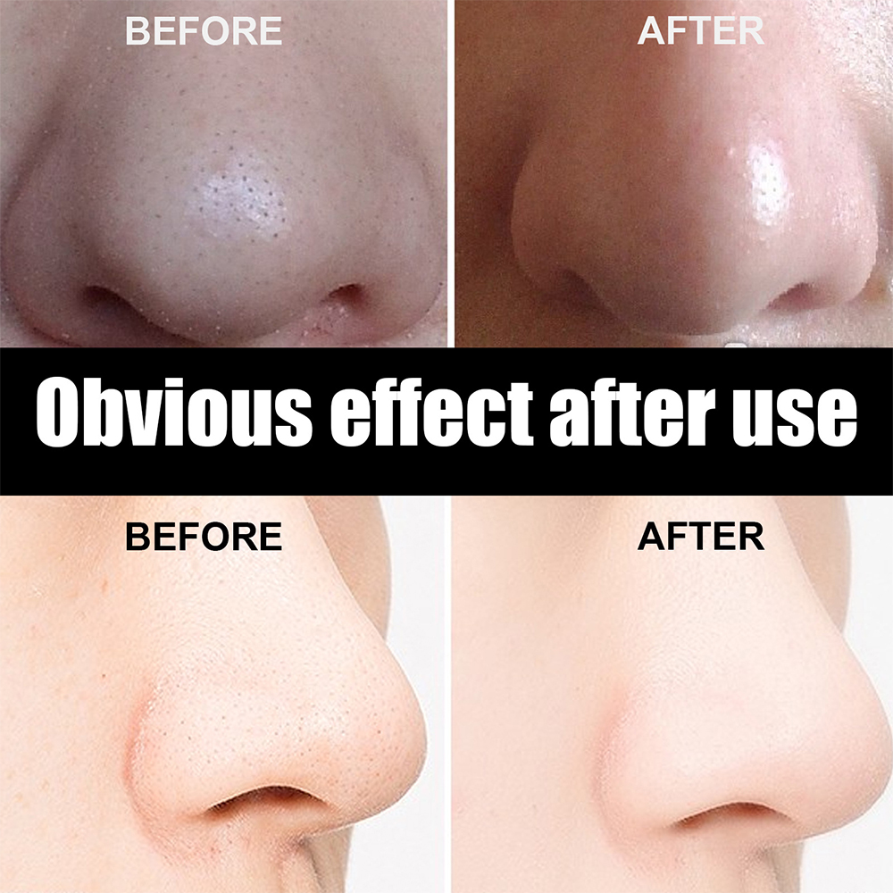 10-60PC%20Nose%20Blackhead%20Remover%20Strip%20Deep%20Cleansing%20Shrink%20Pore%20Acne%20Black%20Dots%20Pore%20Strips%20Face%20Skin%20Care%20Patch%20-%20Image%206