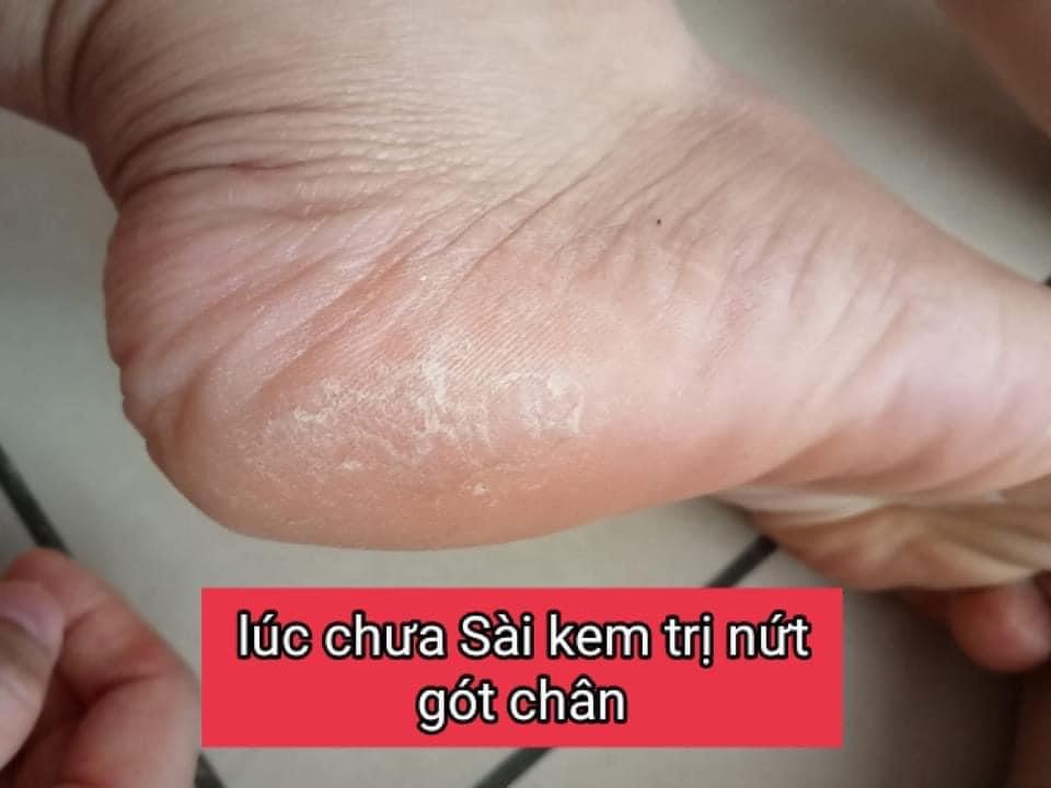 Kem Dưỡng Da Chân- EPOCH SOLE SOLUTION FOOT TREATMENT