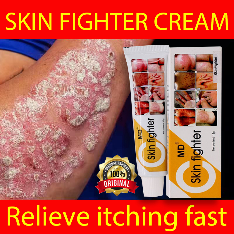 100 Effective Psoriasis Eczema Cream Psoriasis Creams AntiItch Cream
