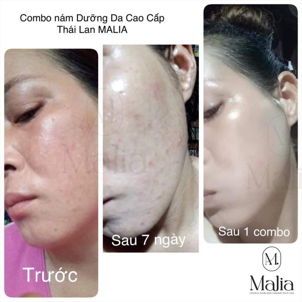 Combo Bộ Dưỡng da cao cấp Thái Lan Malia (Mini size) - Mẫu mới 2022