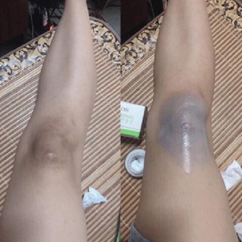 KEM TRỊ THÂM NÁCH, THÂM MÔI, THÂM NHŨ HOA HÀN QUỐC - Ol+Cell