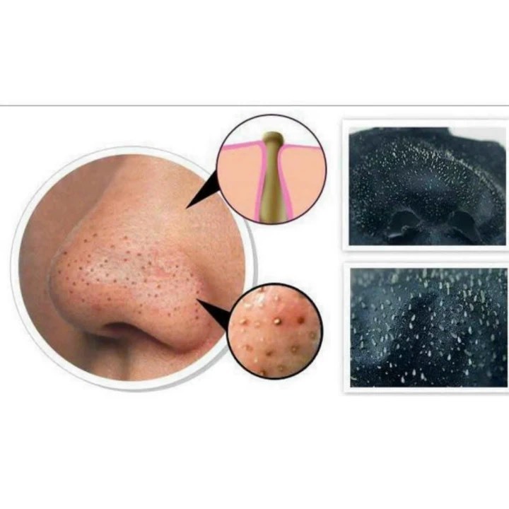 Gel Lột Mụn Cám Kose Softymo Nhật Bản 25G