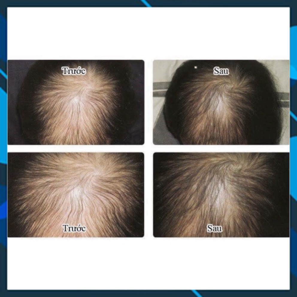 Xịt mọc tóc Minoxidil Bailleul 2% 5% 60ml