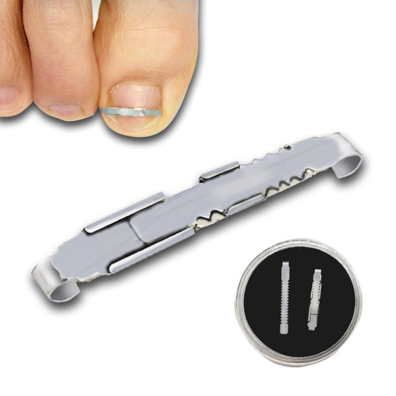 💖 Dụng cụ cố định móng chân mọc ngược dụng cụ nâng sửa móng chân nhúng