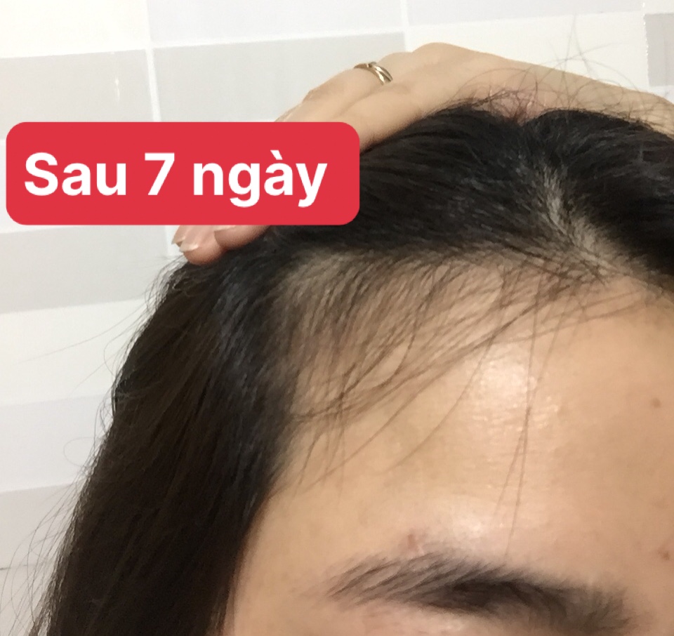 Tinh Dầu Trị Rụng Tóc & Kích Mọc Tóc Kiều Linh