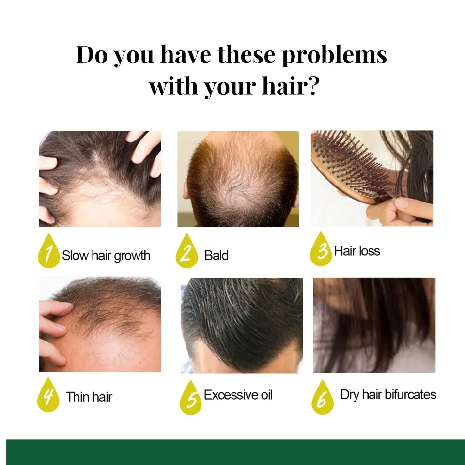 Xịt dưỡng tóc/kích thích mọc tóc nhanh làm dày（Hiệu quả sau 7 ngày）Chiết xuất hoàn toàn từ thiên nhiên / không có tác dụng phụ / giúp giảm rụng tóc / giải quyết vấn đề rụng tóc do lão hóa / hói đầu sau sinh /30ml