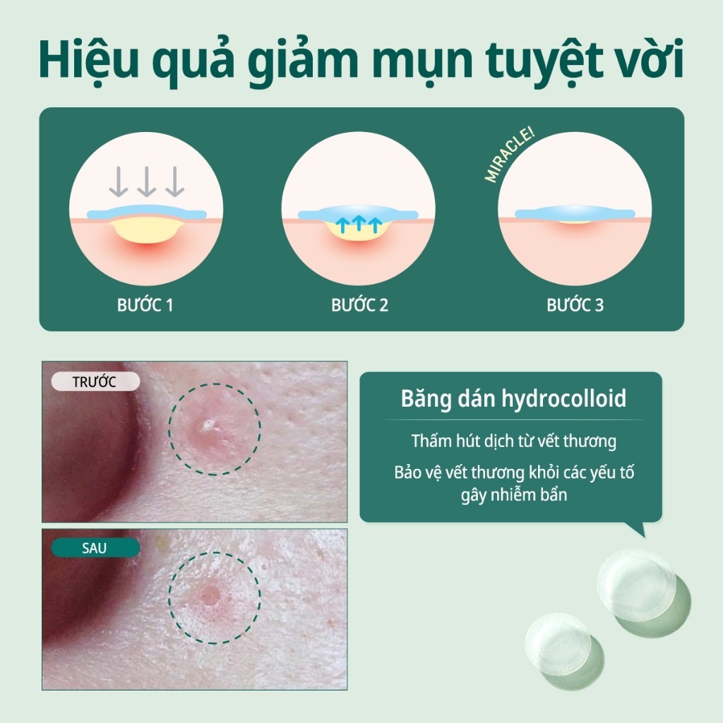Miếng Dán Mụn SOME BY MI 30 Days Miracle Trong Suốt  Rosslyn