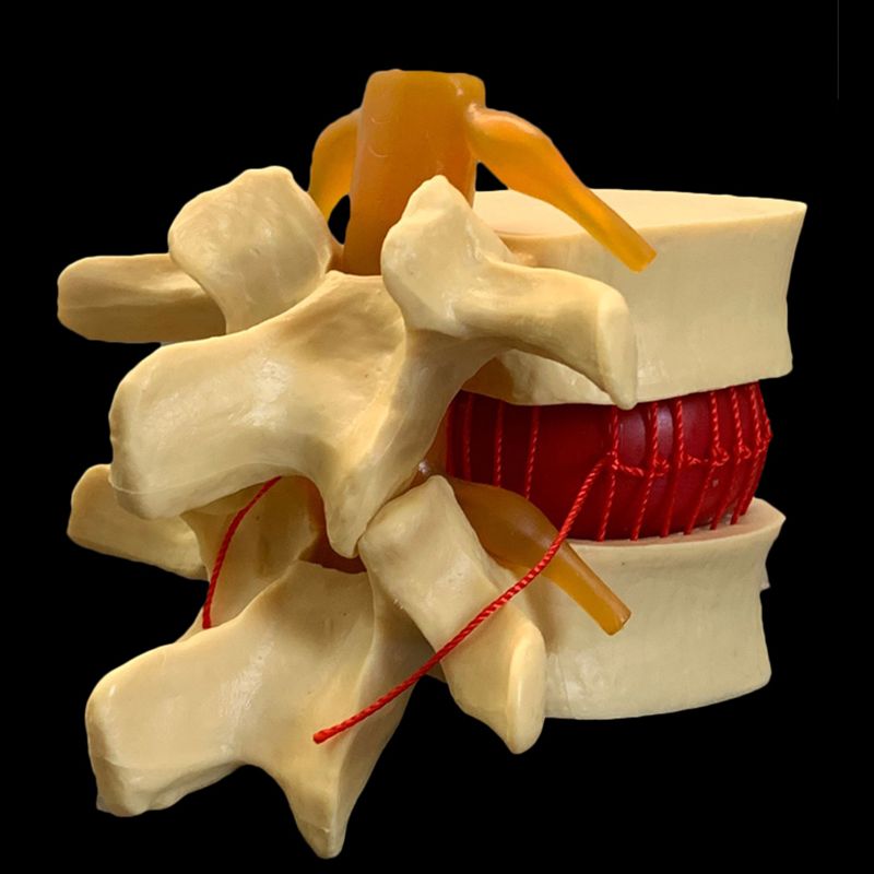Anatomical Human Lumbar Vertebrae Degenerative Lumbar Disc Herniation Demonstration Model Human Spine Model - White, Yellow