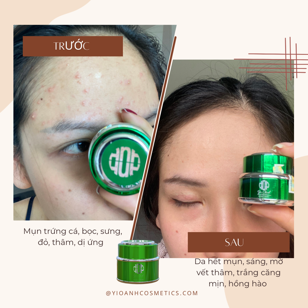 Kem Mụn - Thâm Mụn Acne Cream