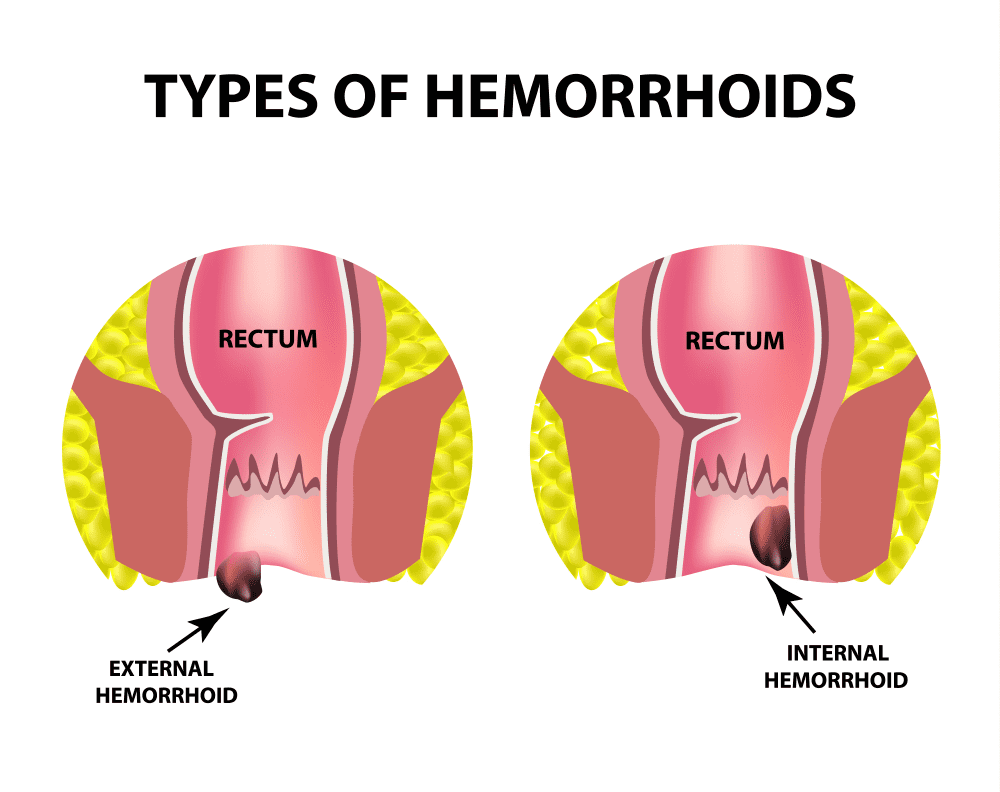[HÀNG MỸ CHÍNH HÃNG] Kem bôi tr_ĩ Preparation H (2 tuýp)