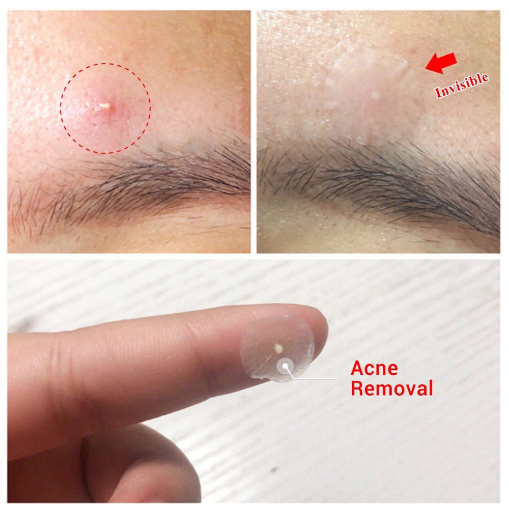 Miếng dán mụn Lanbena Acne Pimple Patch