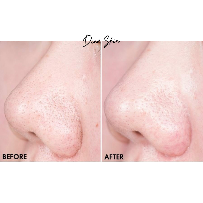 1 MIẾNG _HATHERINE PORE CLEAR NOSE PACK_MIẾNG DÁN LỘT MỤN MŨI