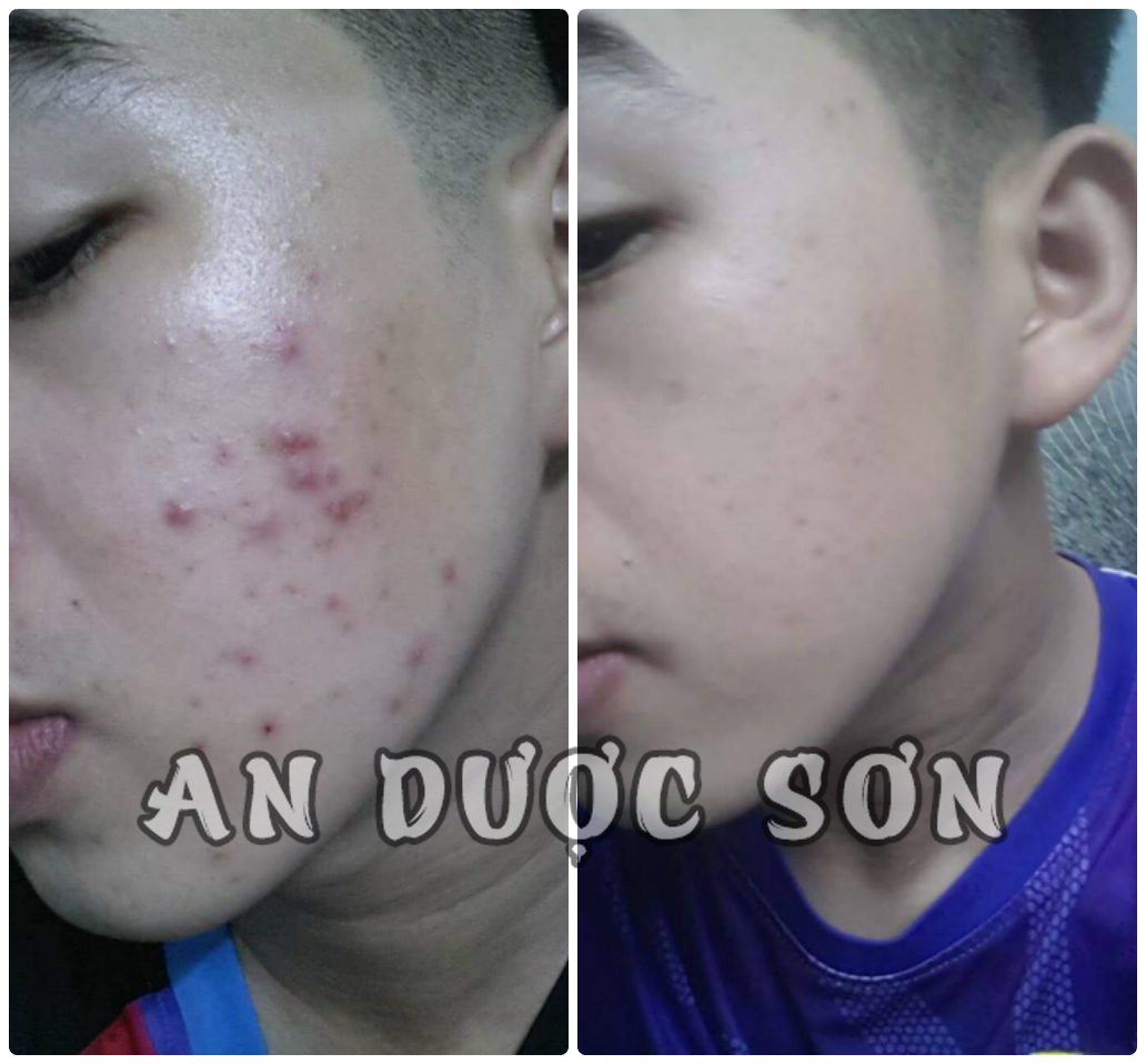 Bộ Ngừa Mụn An Dược Sơn Đánh Bay Mụn