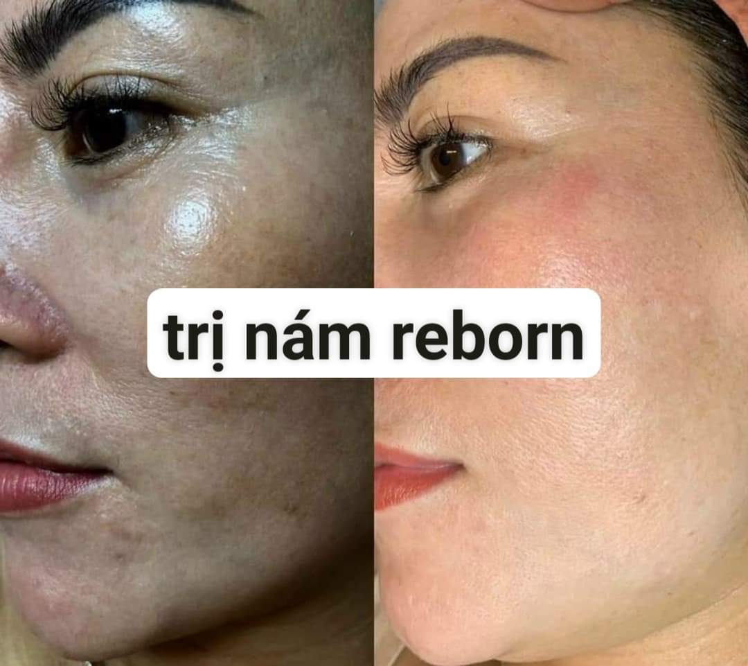 [Tri Nám, Tàn Nhang]Kem Nám Reborn