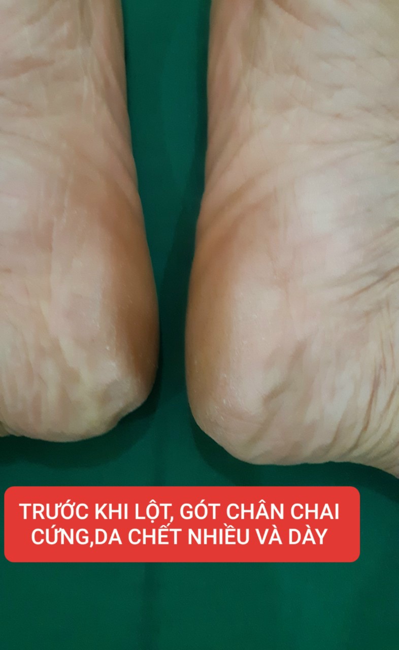 ủ chân lột da chết  nhật