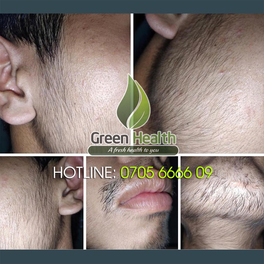 Serum Hỗ Trợ Mọc Râu Quai Nón Minoxidil 12,5% Morr