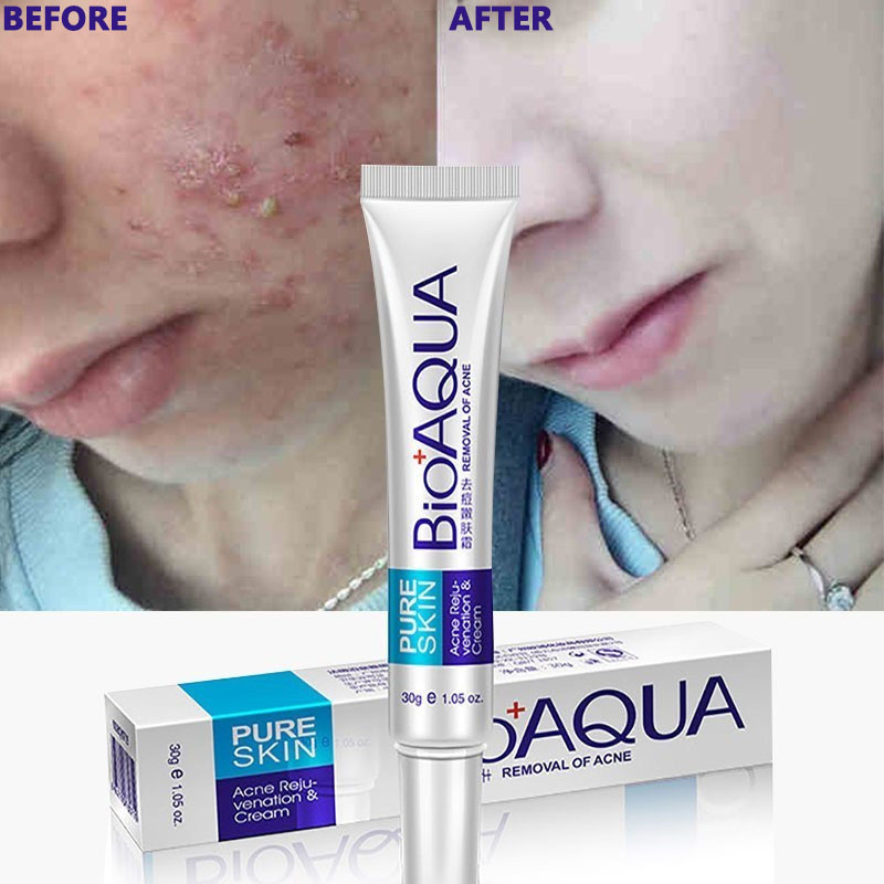 Bioaqua%20Mark%20Removal%20Gel%20Ointment%20Pure%20Anti%20Acne%20Cream%2030G%20-%20Image%202