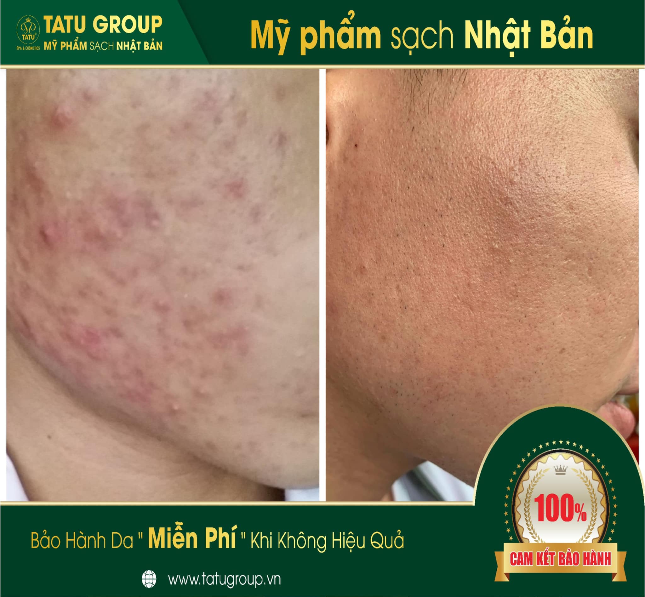 Kem mụn trắng da Tatu S1 10g