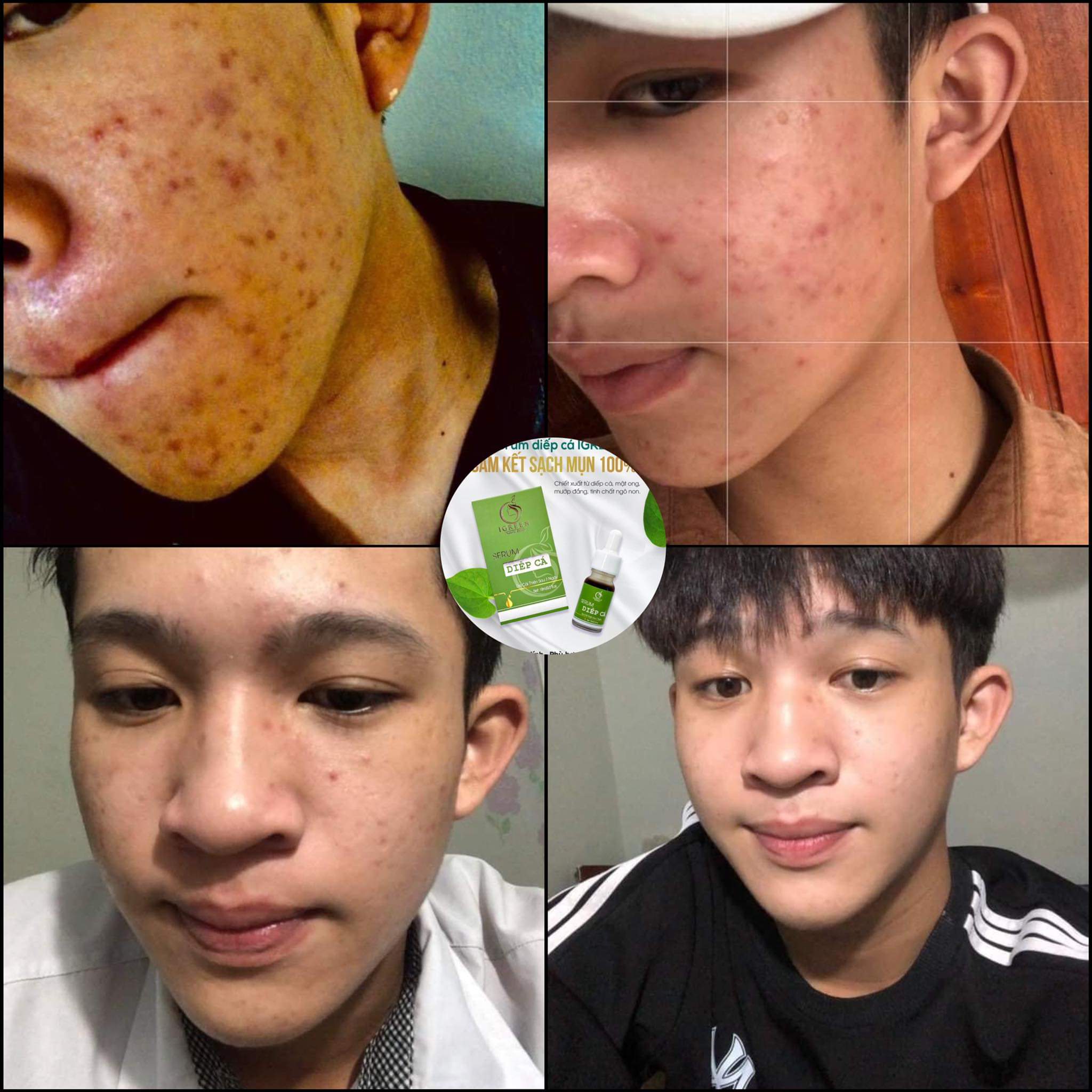 Serum diếp cá