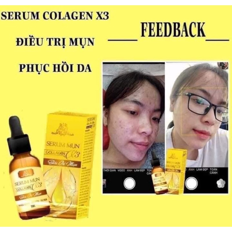 Serum mụn collagen x3 chính hãng