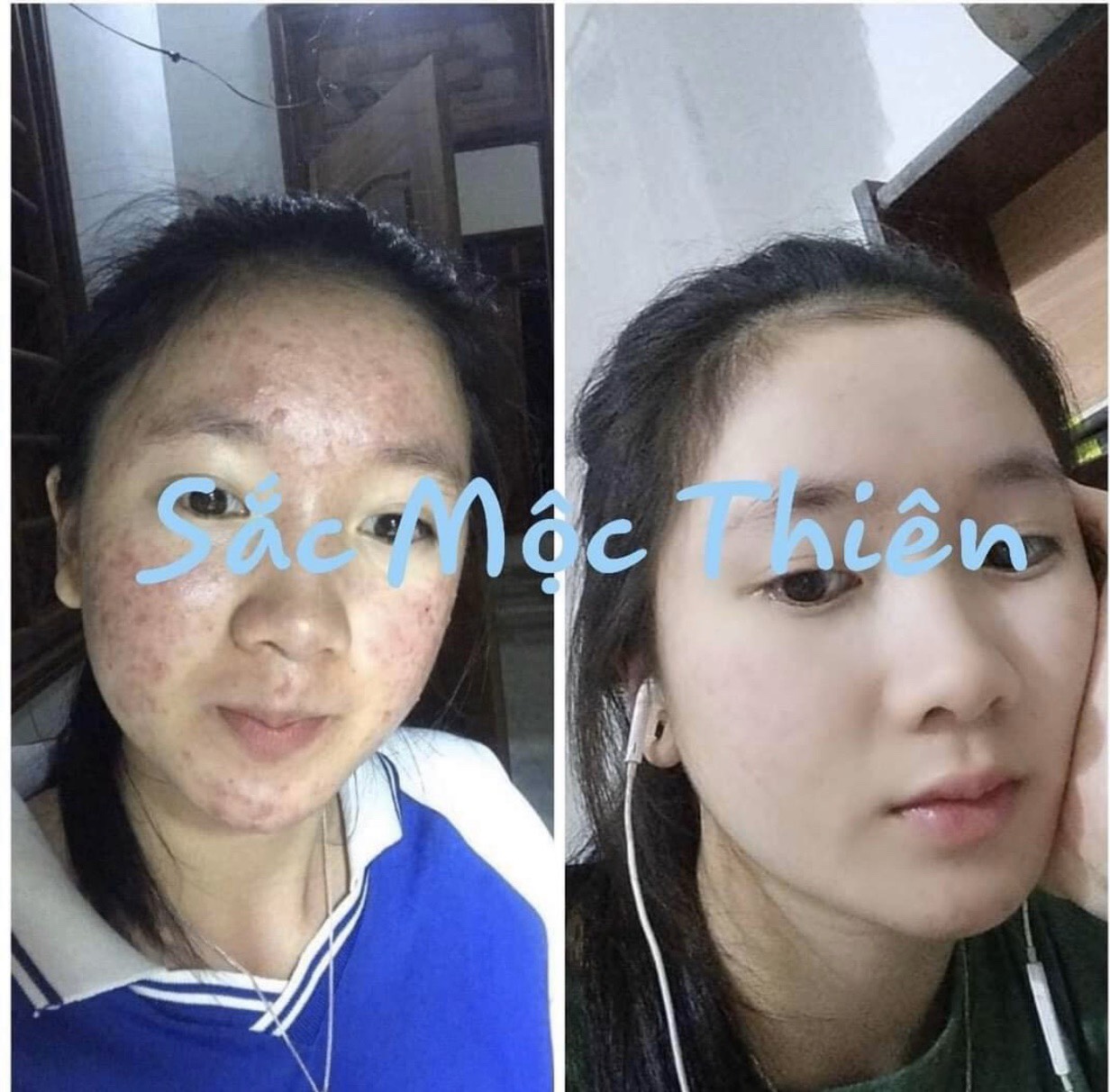 Mặt Nạ Thải Độc Tố Mụn Ẩn Sắc Mộc Thiên